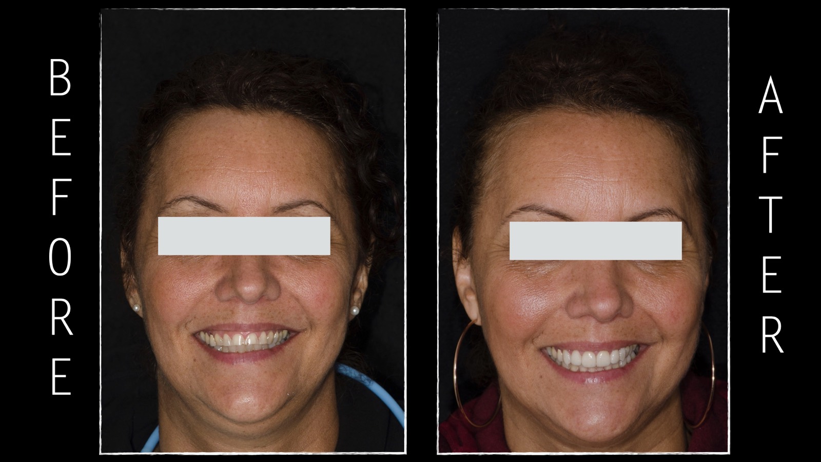 Cosmetic dentistry transformation by Dr. Seema