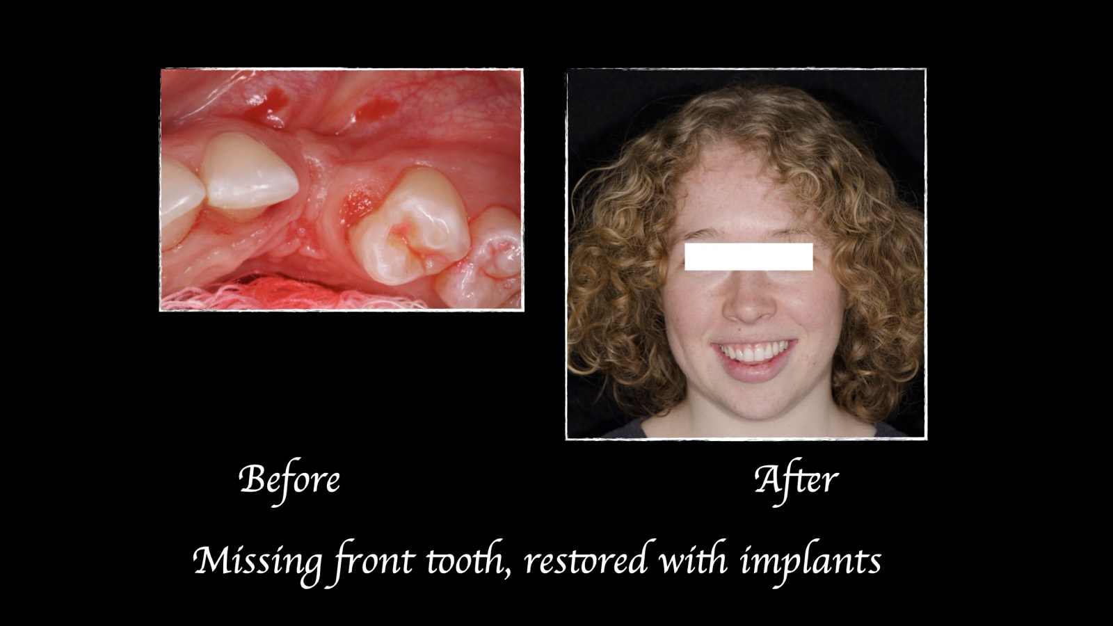 Dental implant case