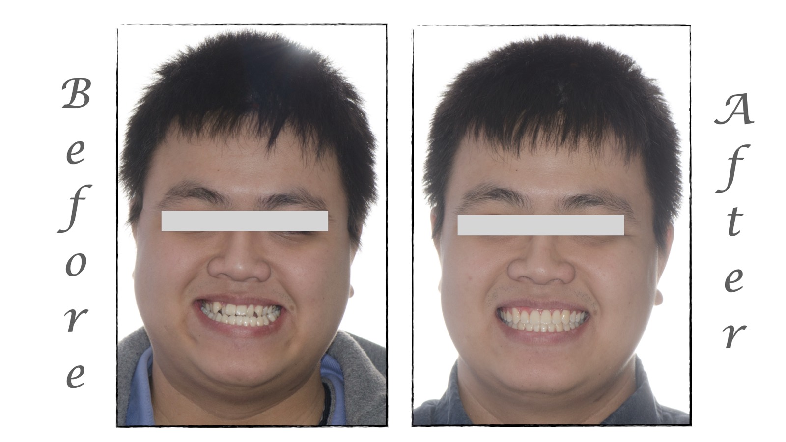 Orthodontic transformation by Dr. Chirag